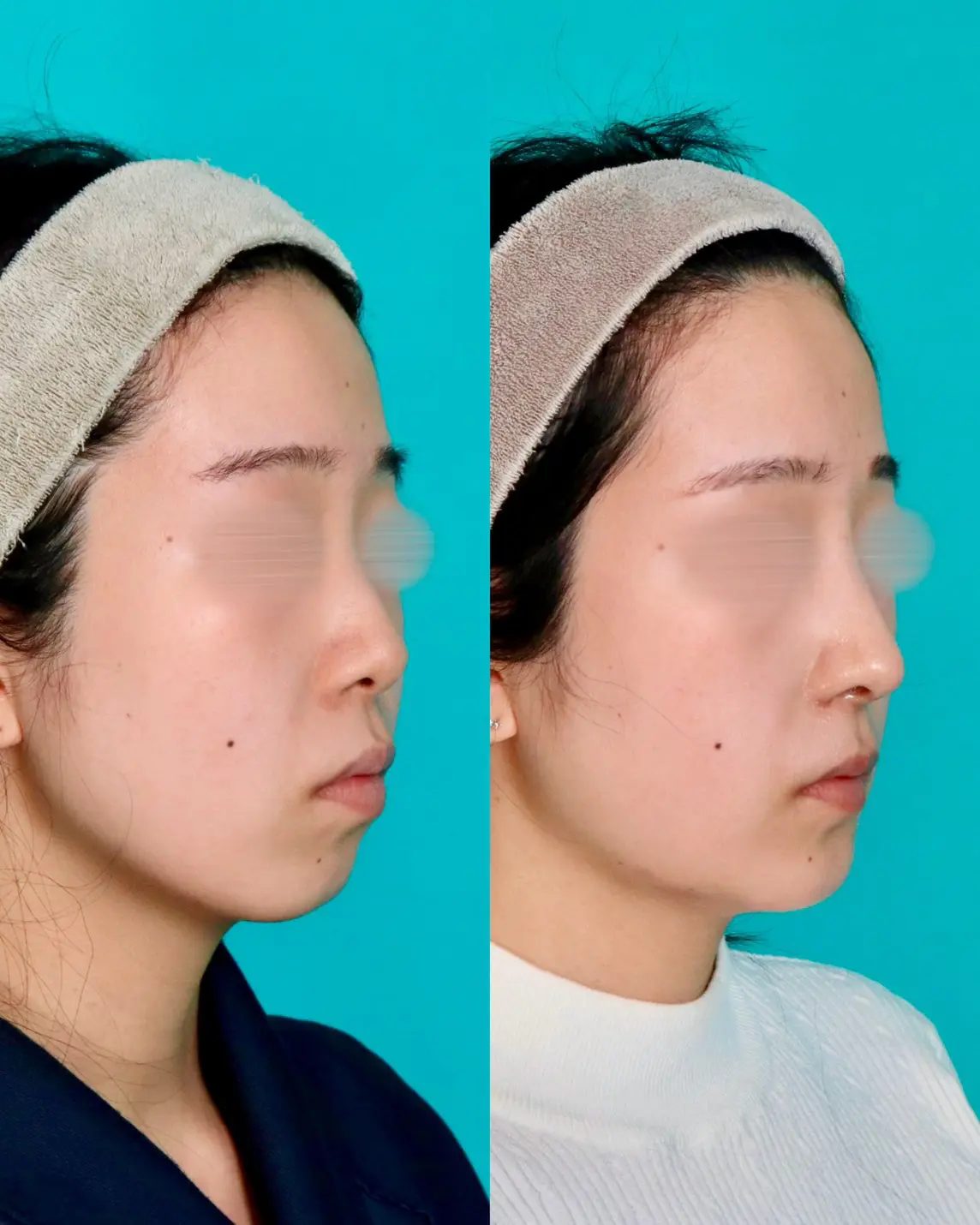 施術前後イメージ