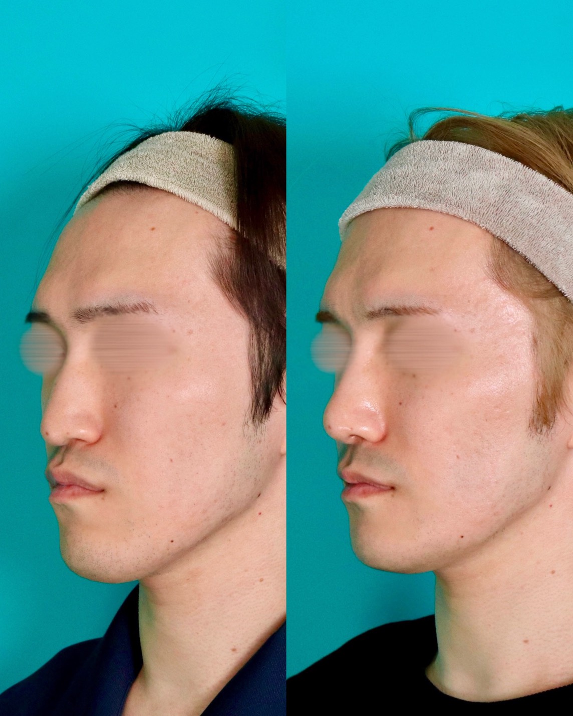 施術前後イメージ