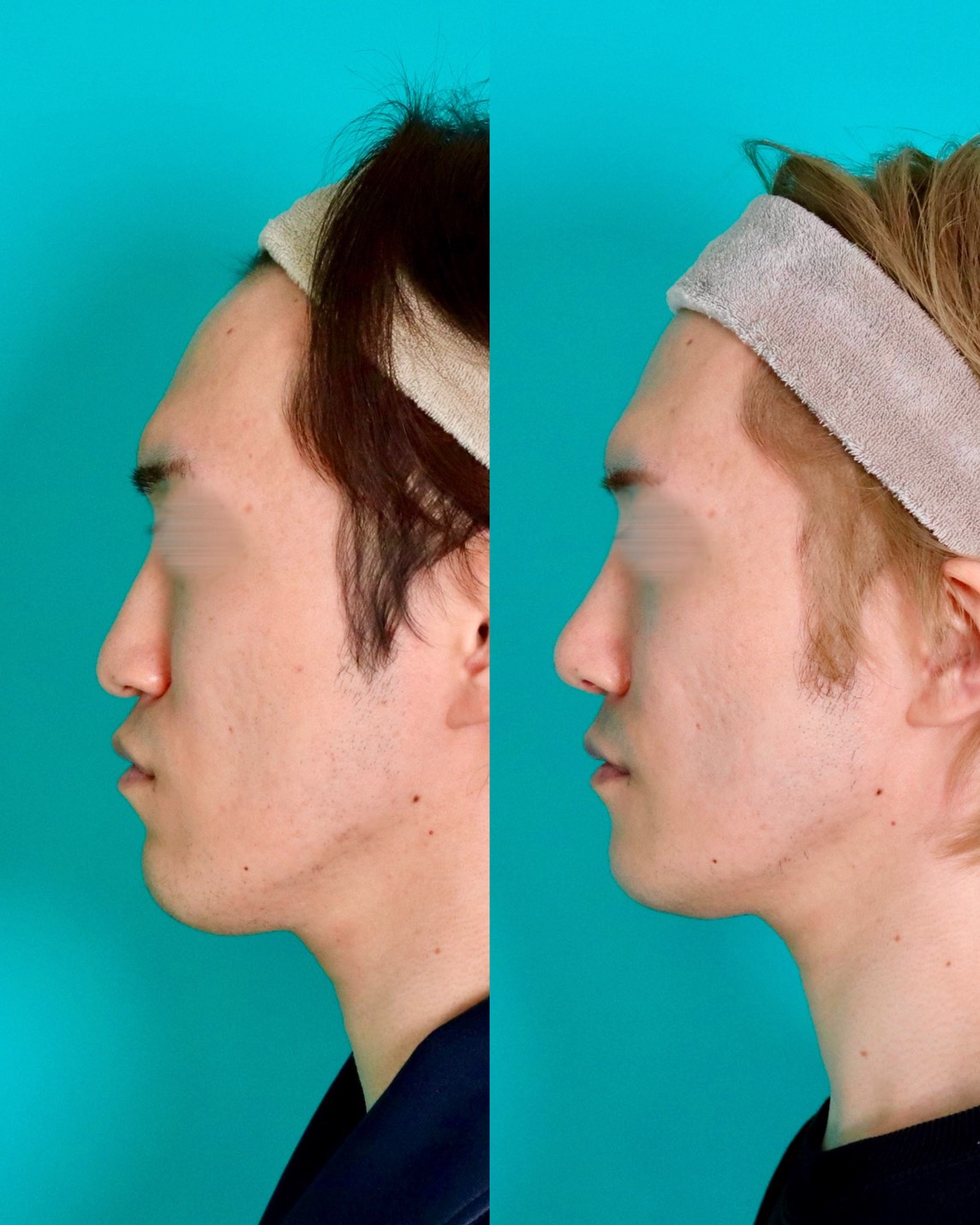 施術前後イメージ