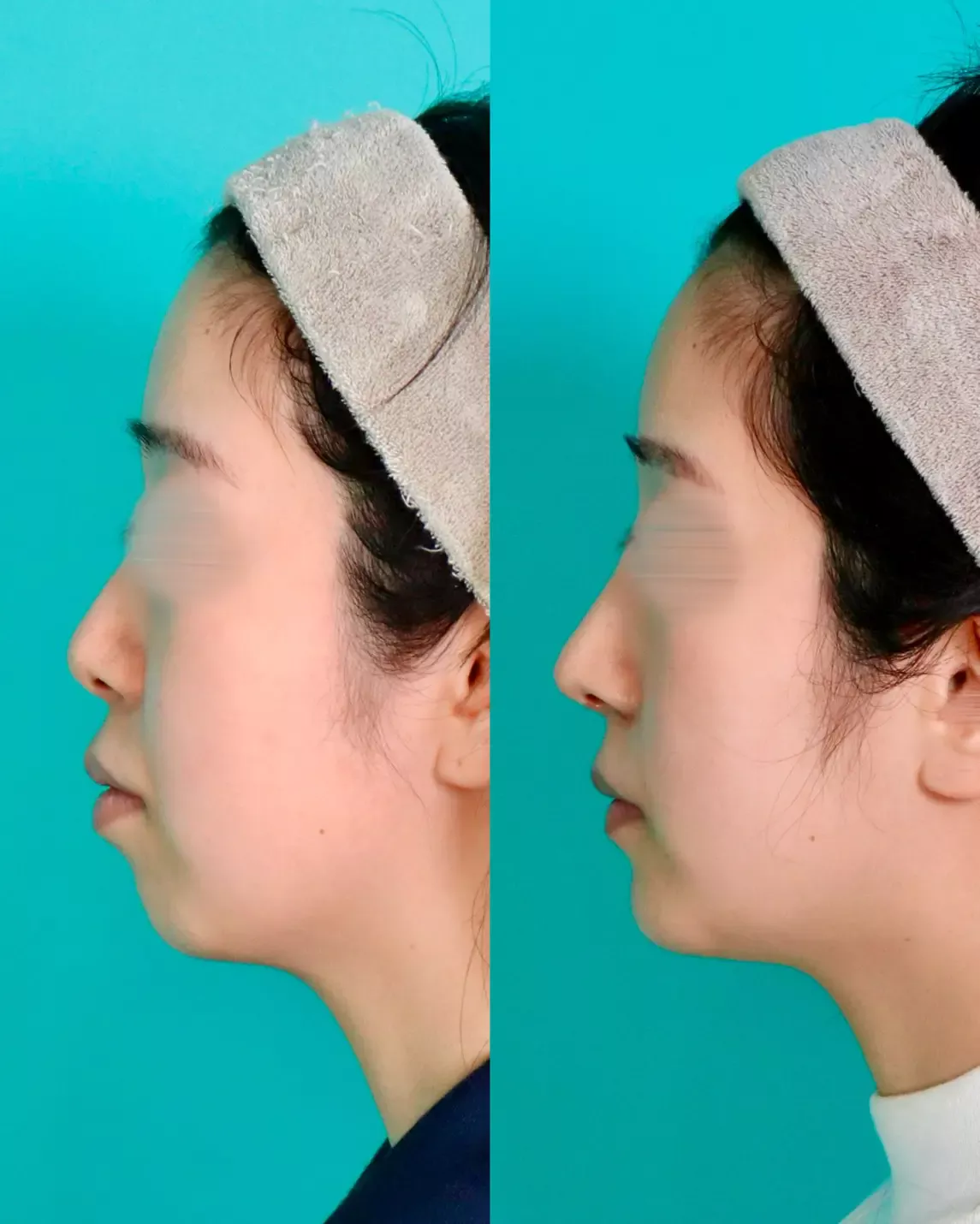 施術前後イメージ