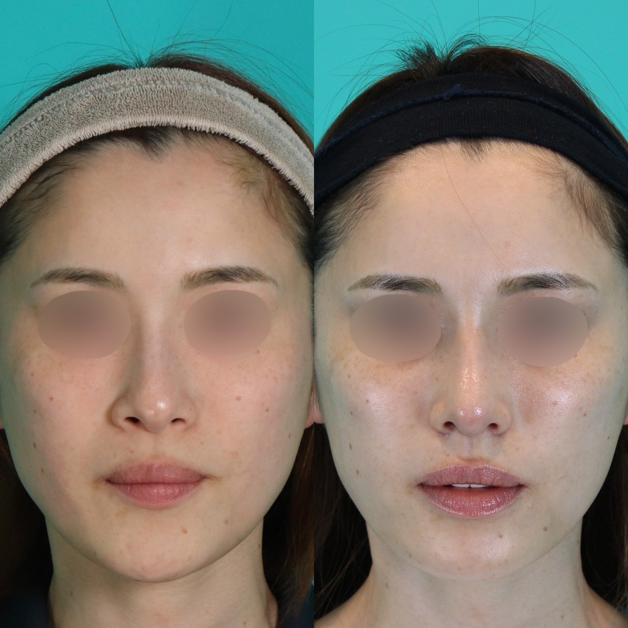鼻フルコースプレミアム施術前後イメージ