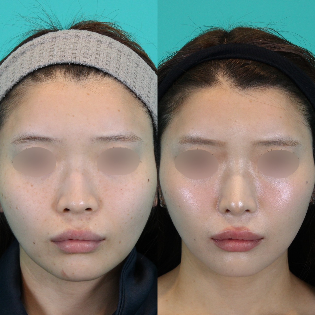 鼻フルコース忘れ鼻　２０代女性施術前後イメージ