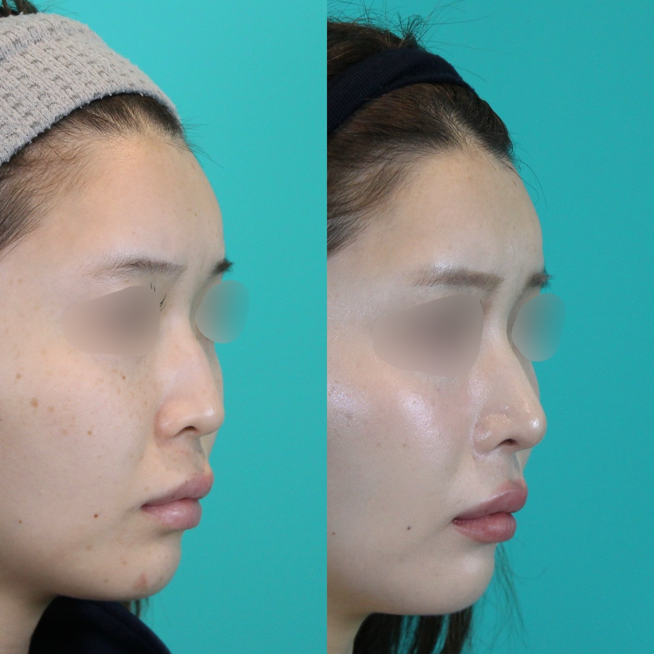 施術前後イメージ