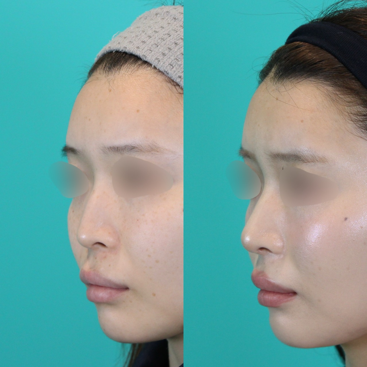 施術前後イメージ