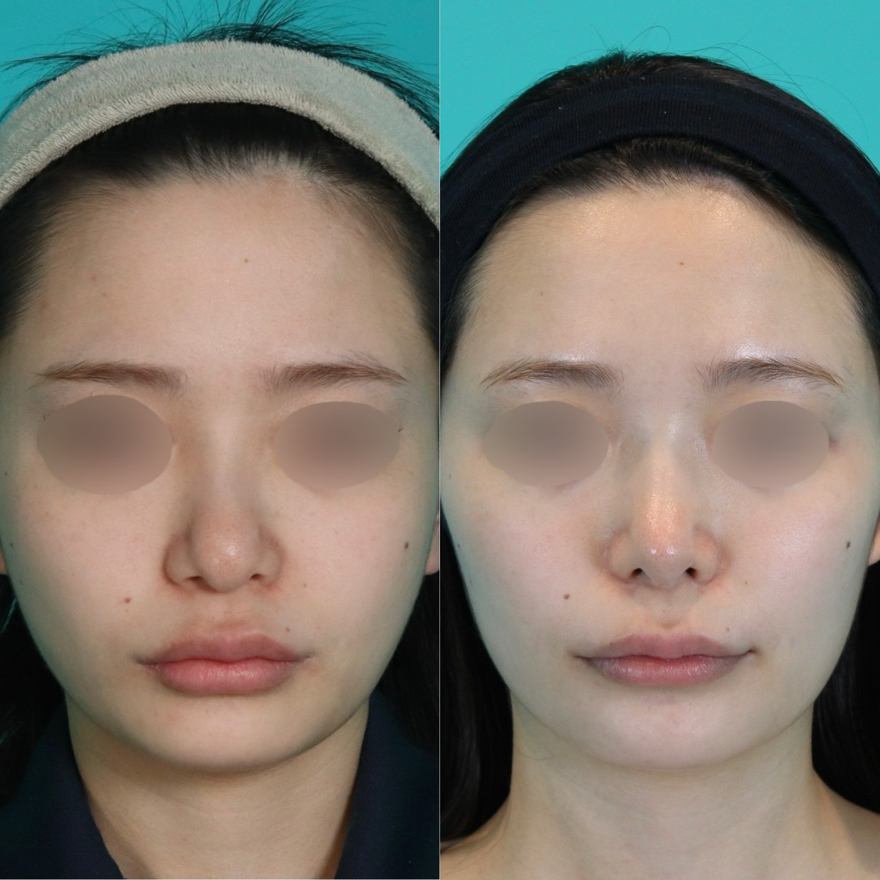 鼻フルコース忘れ鼻施術前後イメージ