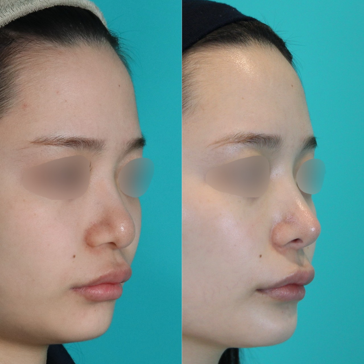 施術前後イメージ