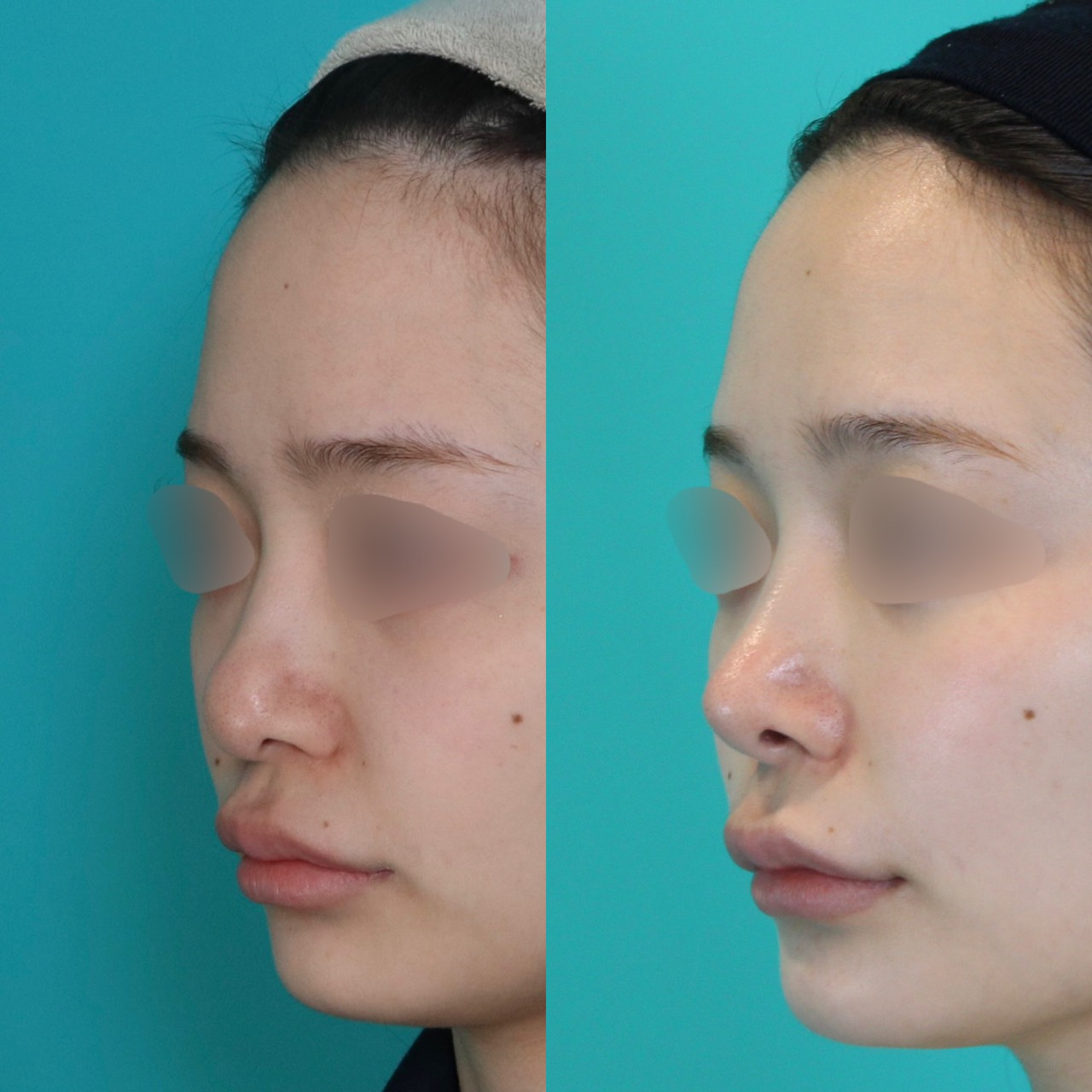 施術前後イメージ