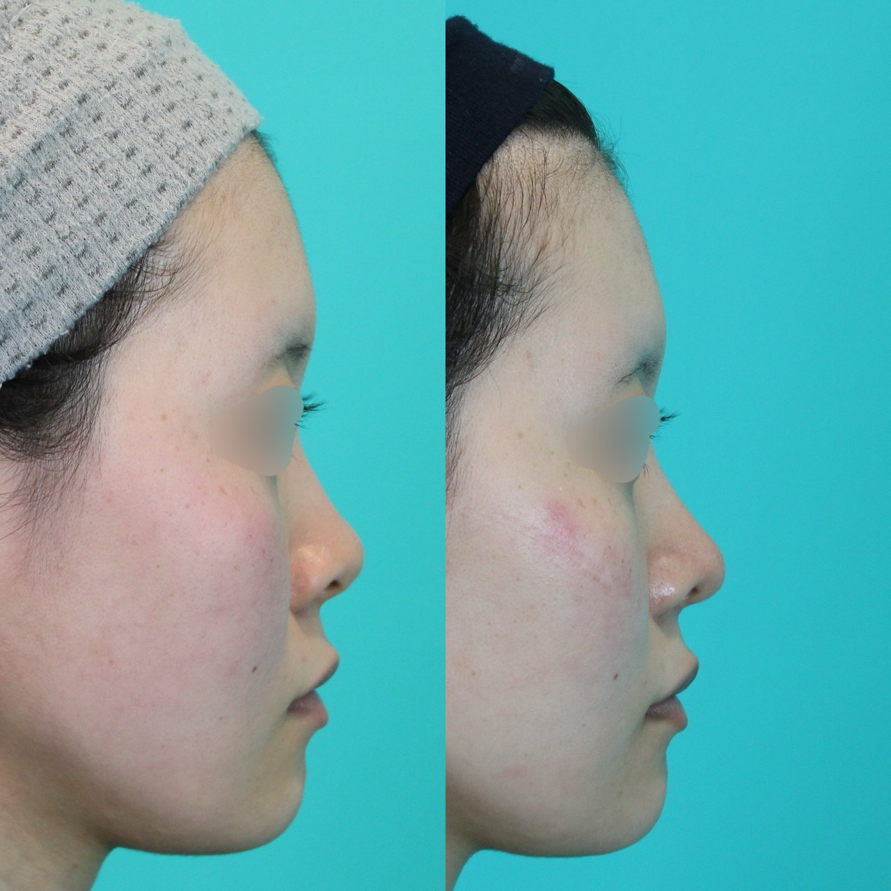 施術前後イメージ