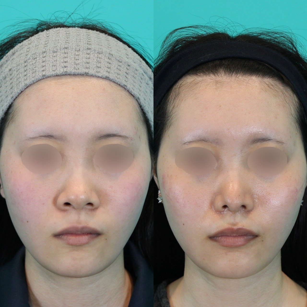 鼻フルコースベーシック　２０代女性施術前後イメージ