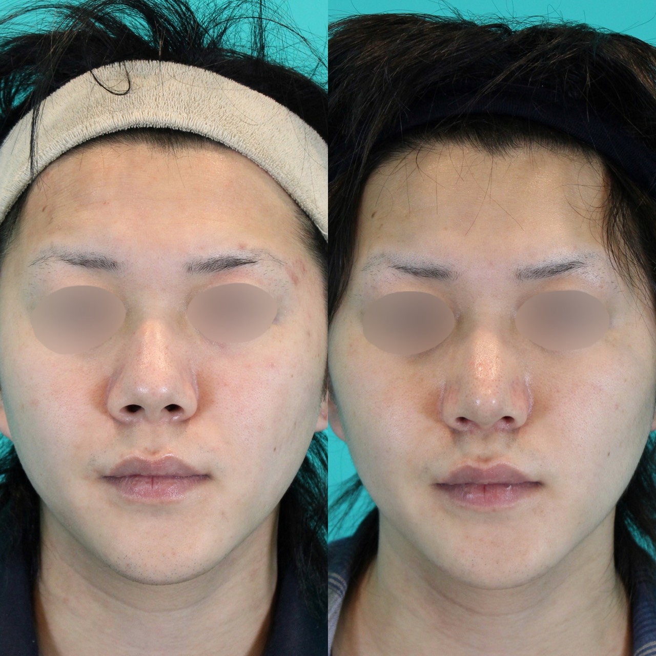 鼻フルコースプレミアム　男性施術前後イメージ