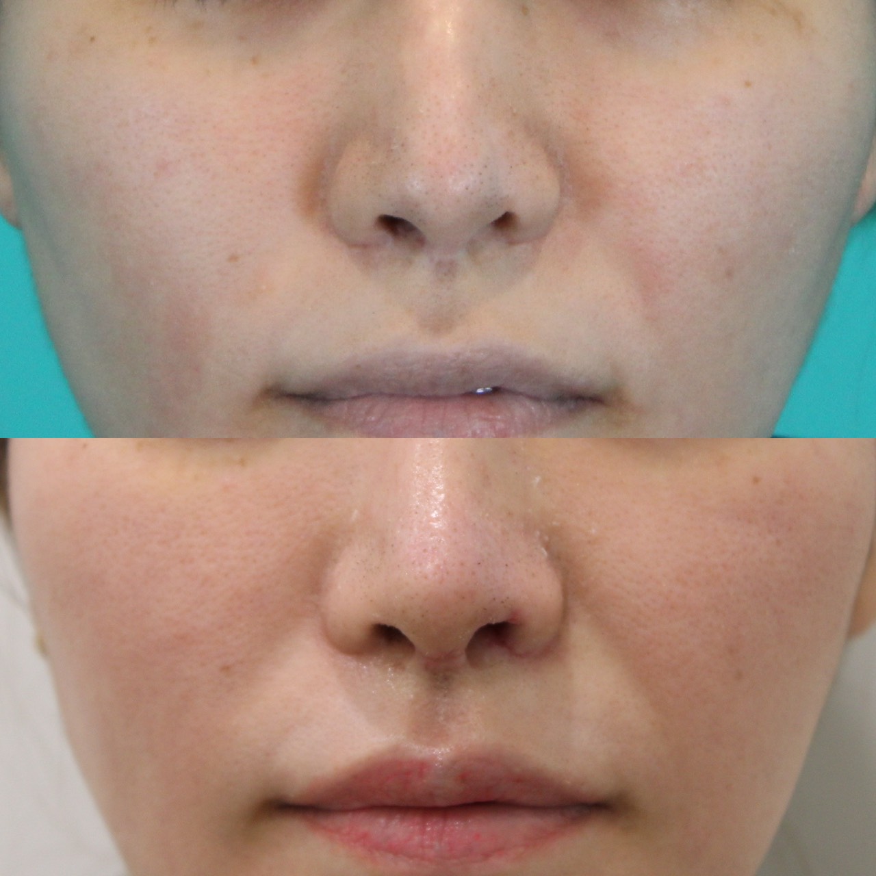 鼻フルコースベーシック　施術前後イメージ