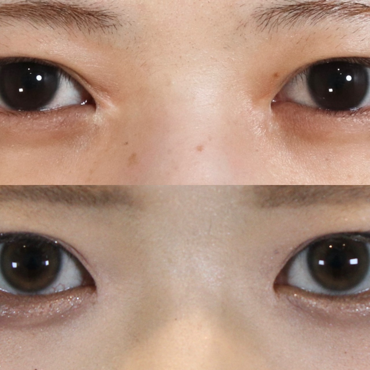 目頭切開修正　２０代女性施術前後イメージ