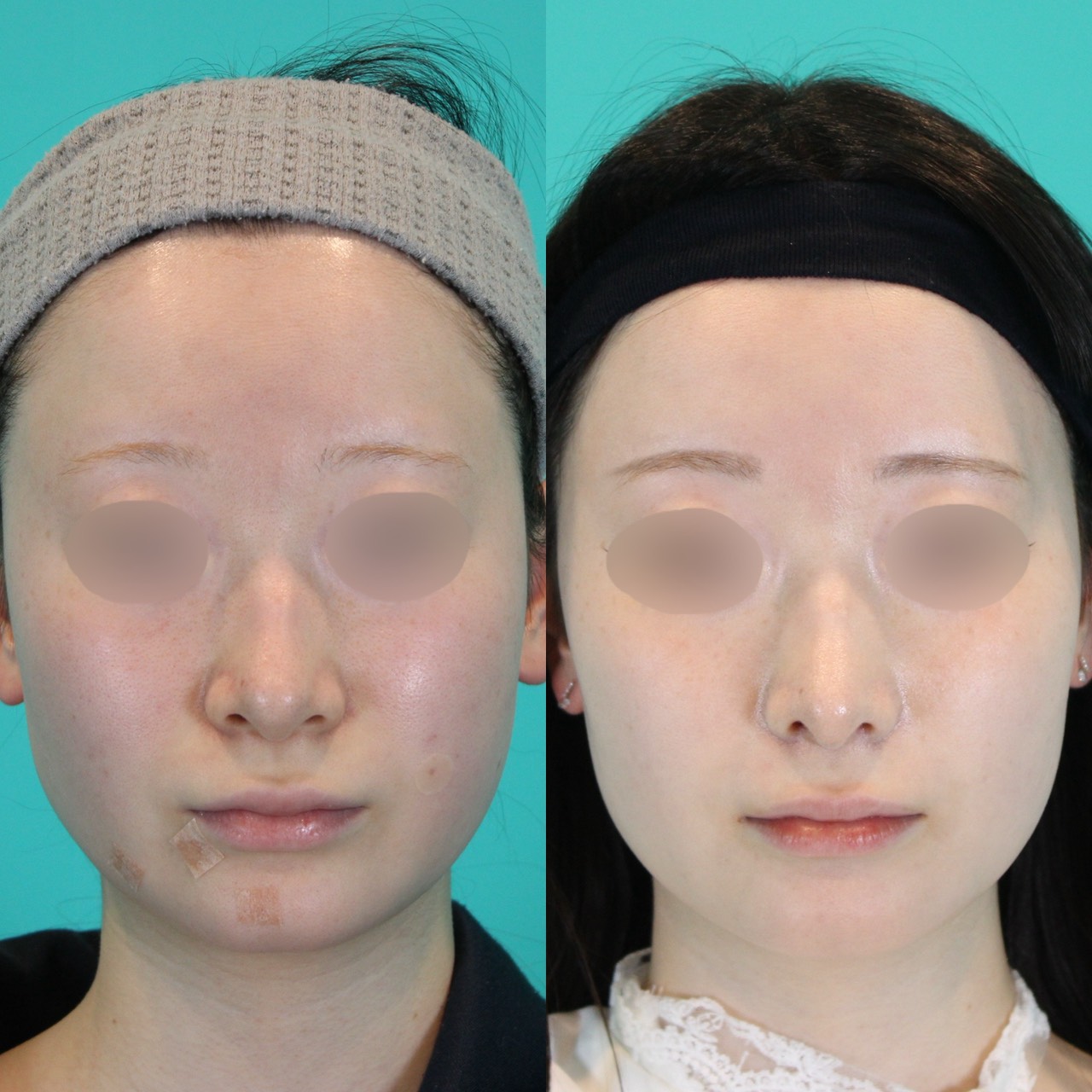 施術前後イメージ