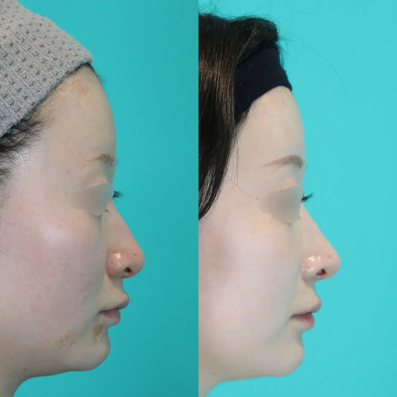 施術前後イメージ