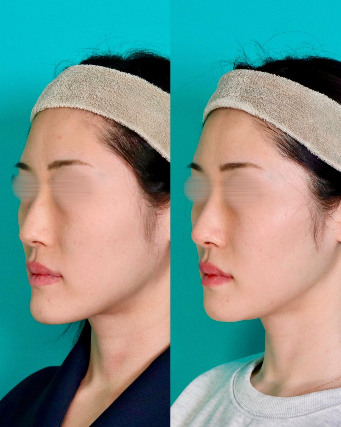 施術前後イメージ