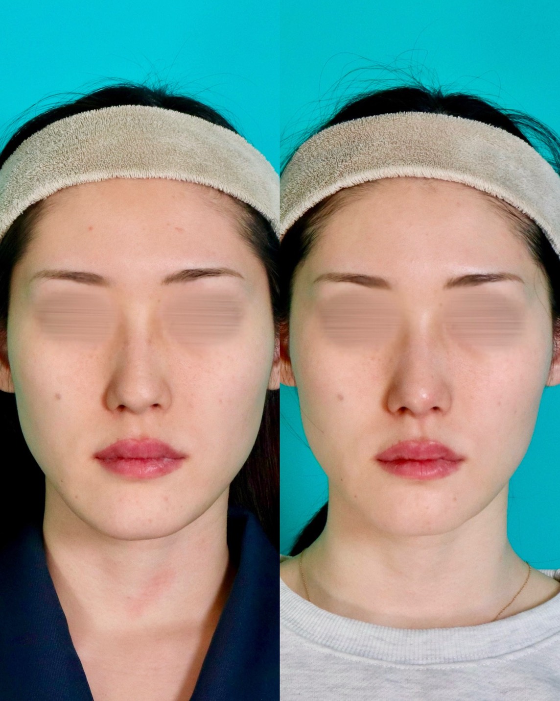 オトガイ中抜き形成、顎肉切除口腔内法施術前後イメージ