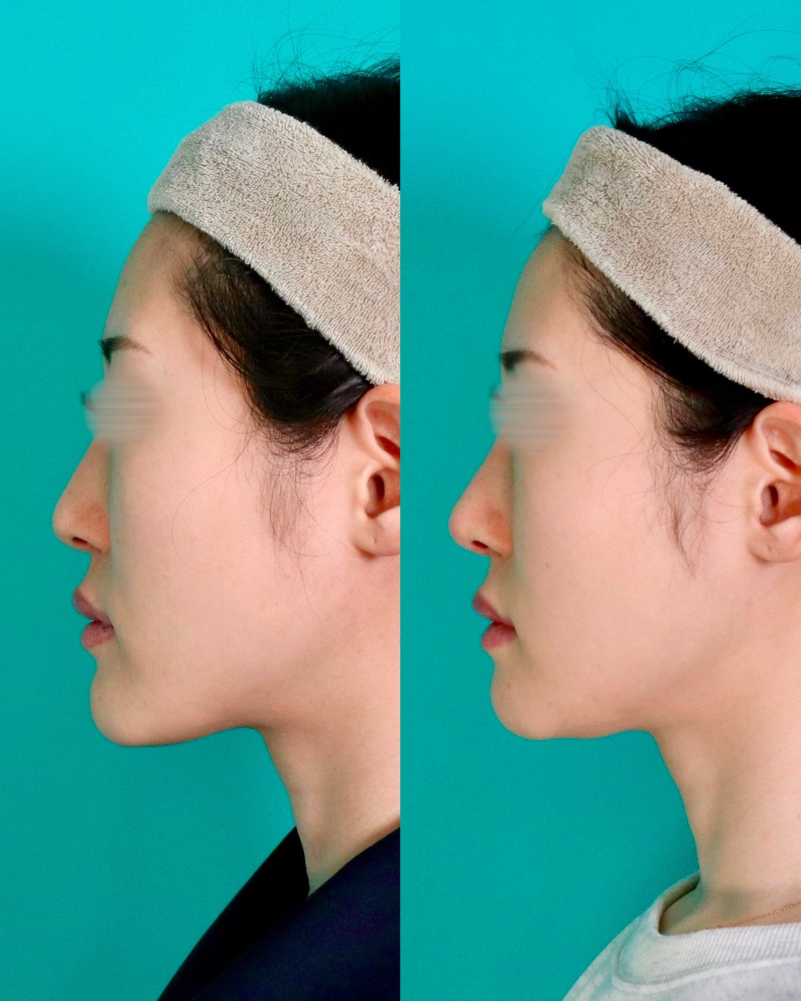 施術前後イメージ