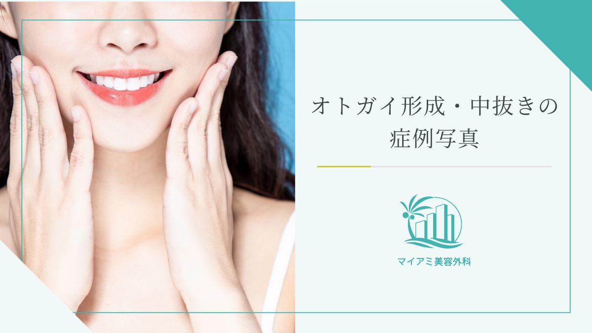 オトガイ形成・中抜きの症例写真
