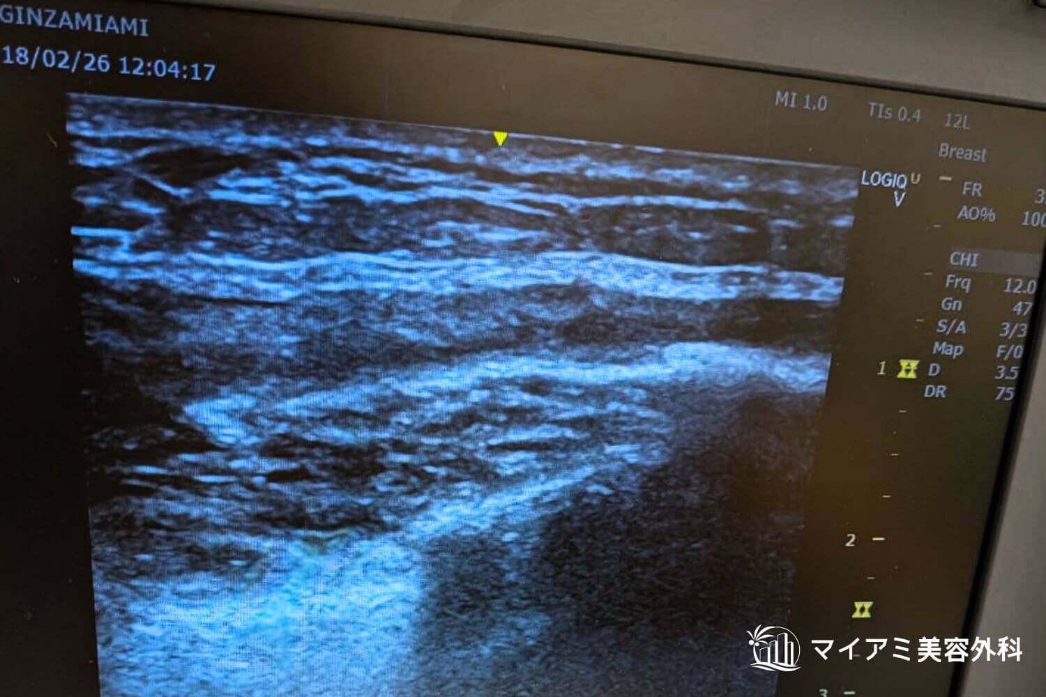 吸引後のアクアフィリングのエコー画像