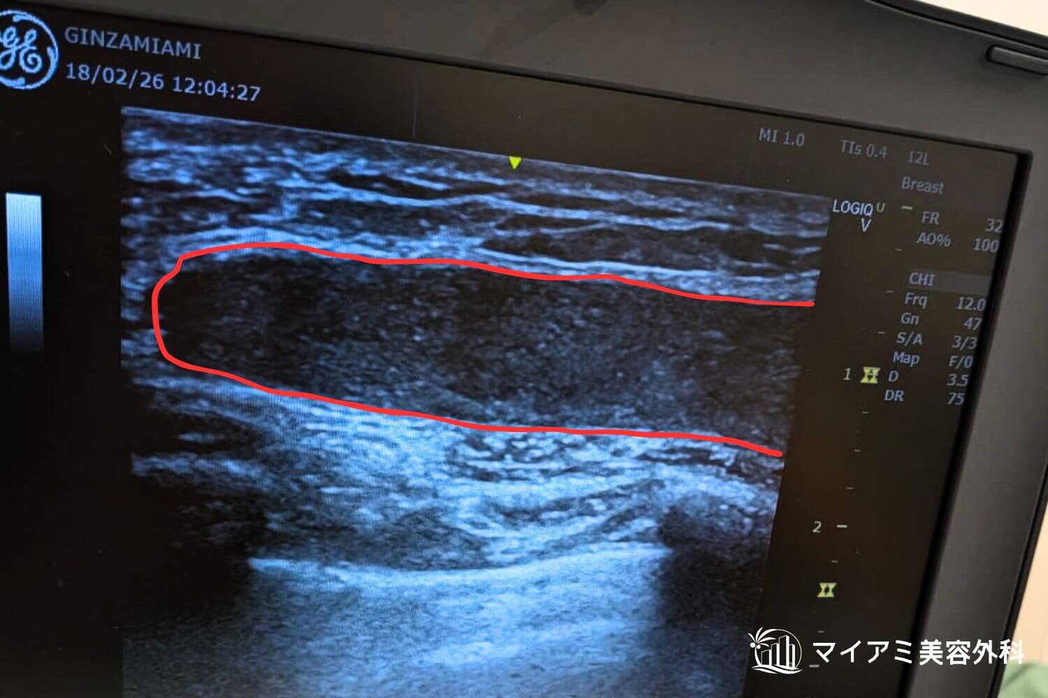 吸引前のアクアフィリングのエコー画像