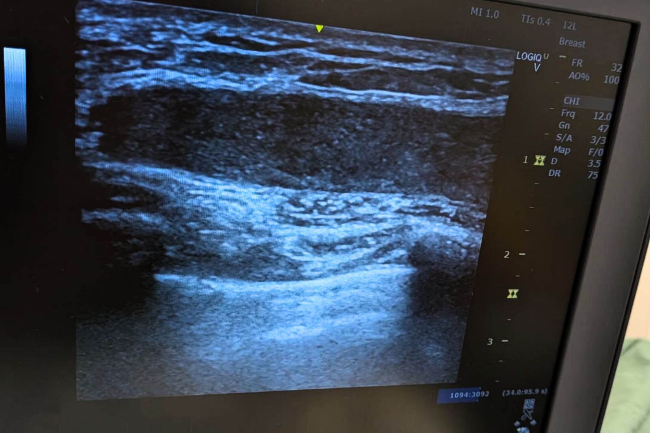 高精度エコーによるフィラーの広がり診断