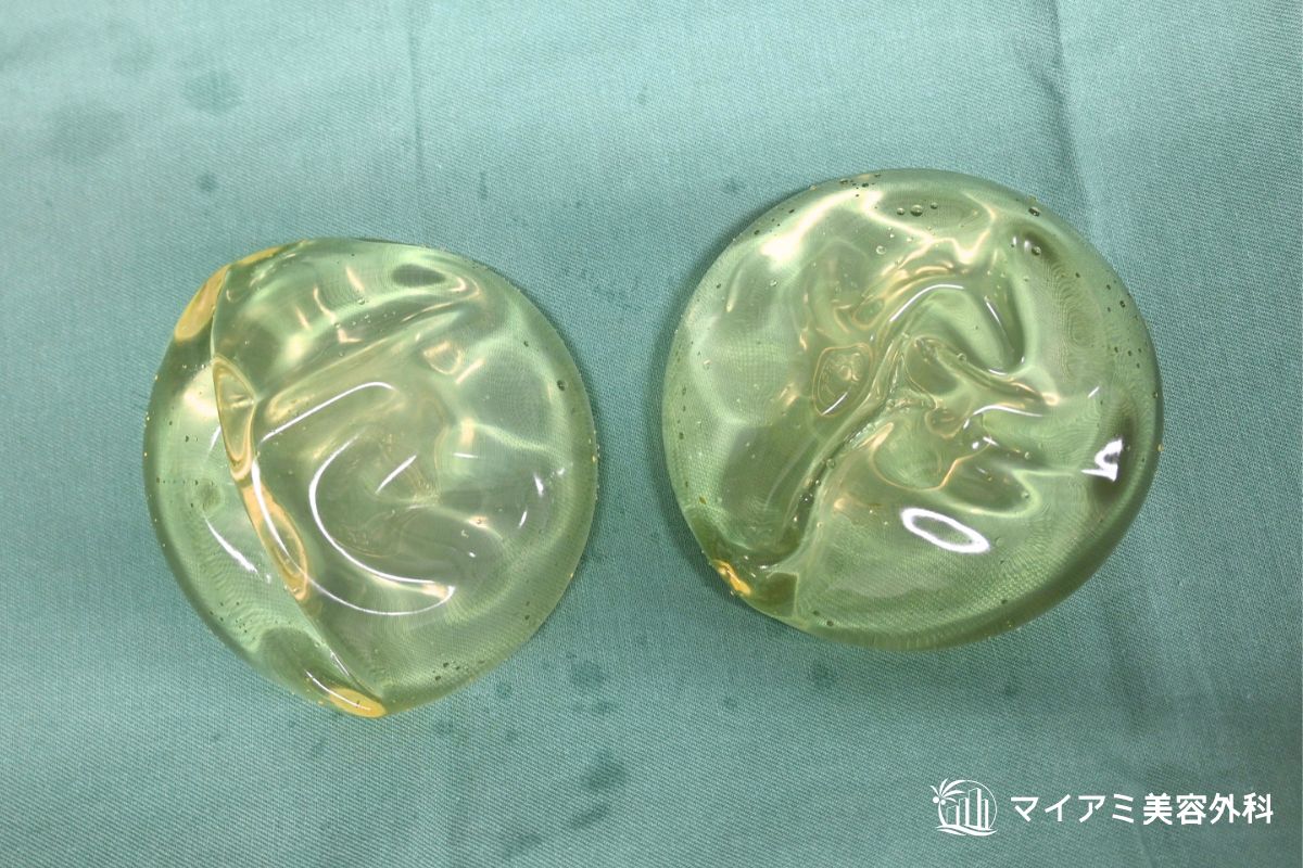 波打ちが起きているシリコンバッグ