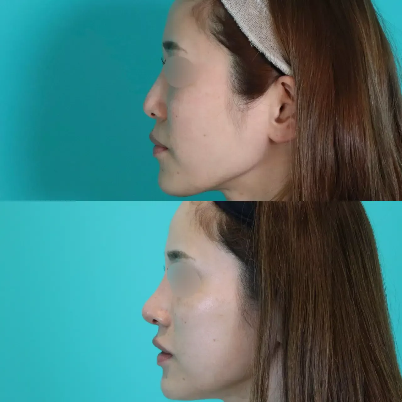 施術前後イメージ