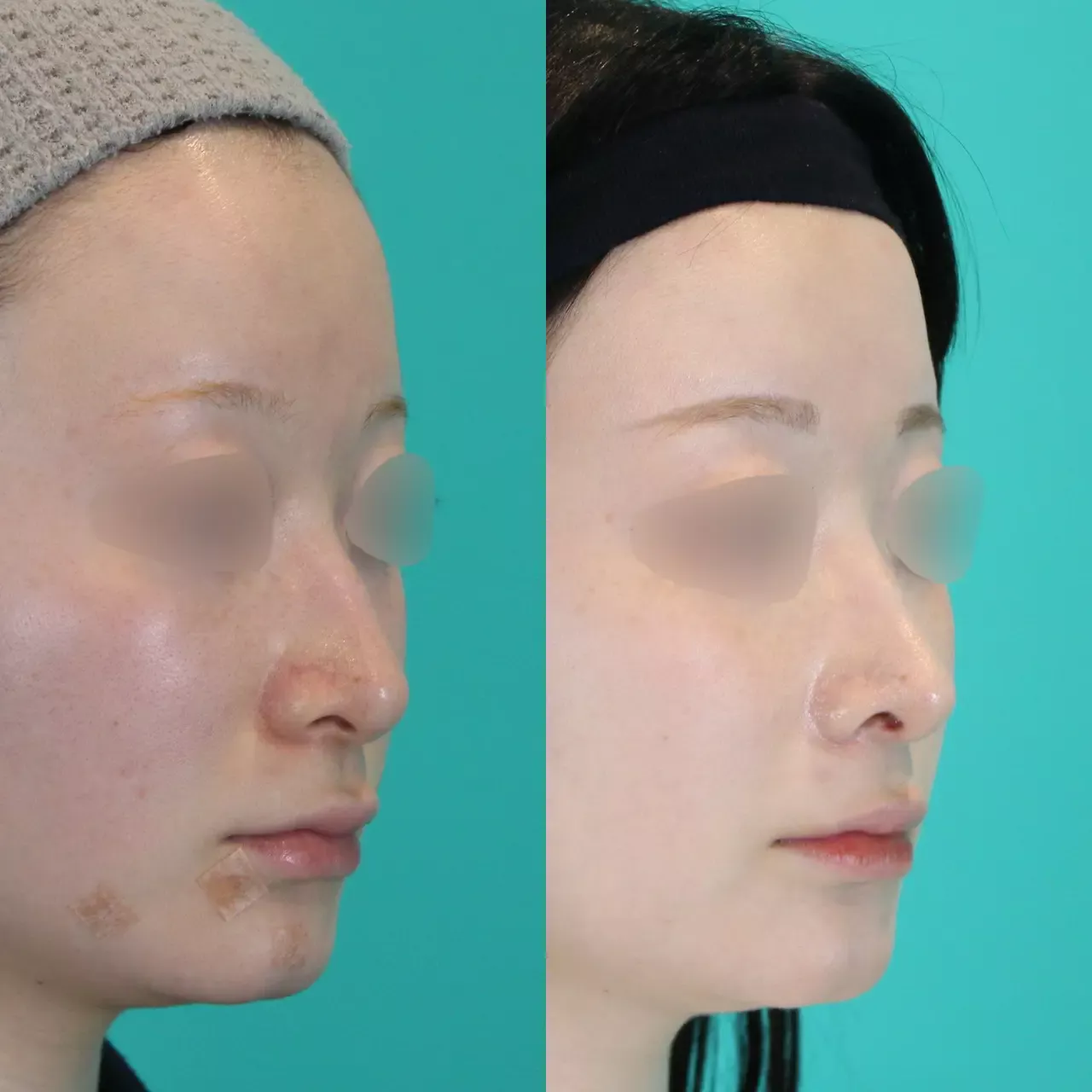 施術前後イメージ