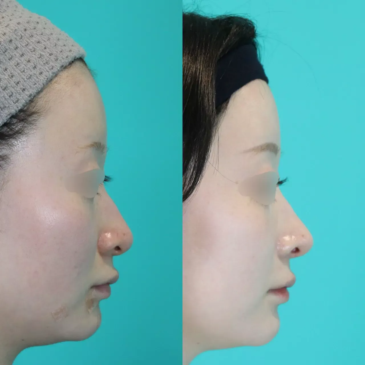 施術前後イメージ