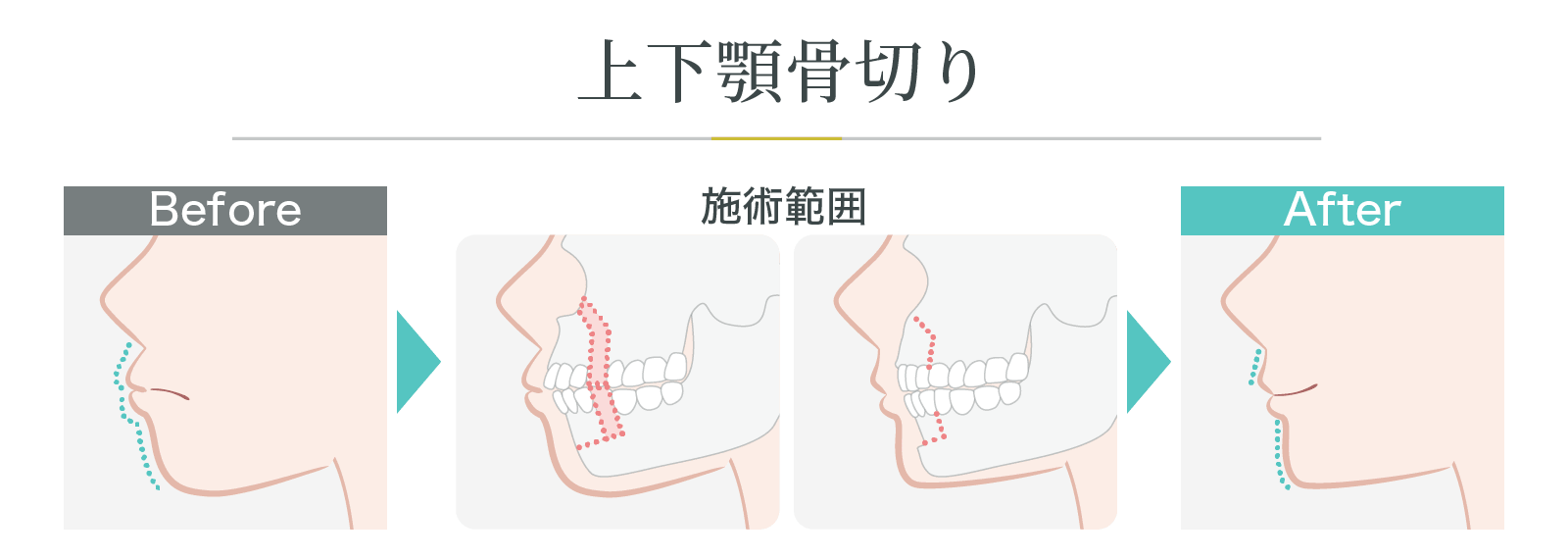 上下顎骨切り