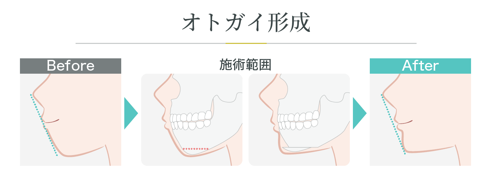 オトガイ形成