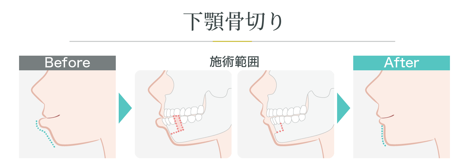 下顎骨切り