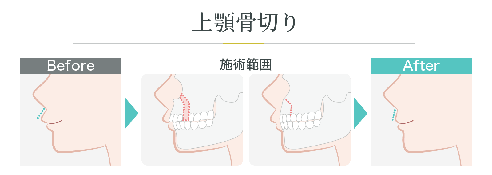 上顎骨切り