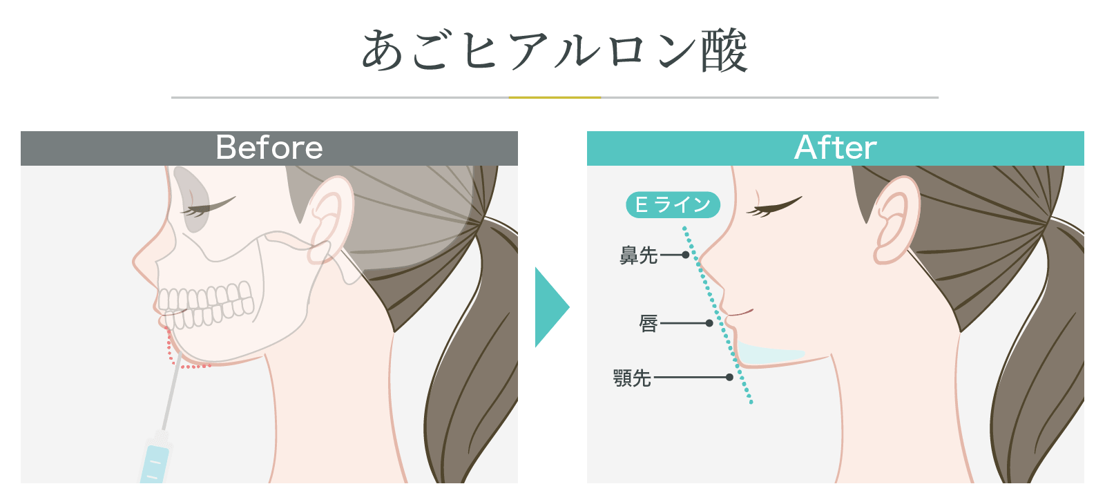 ヒアルロン酸