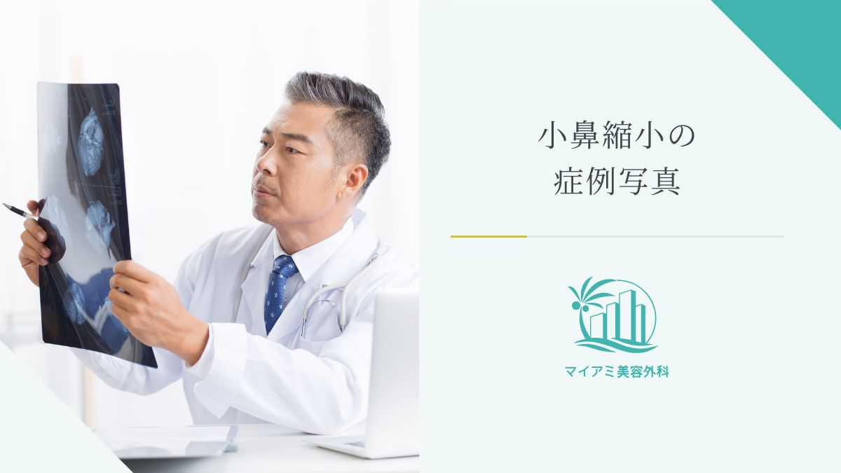 小鼻縮小の症例写真