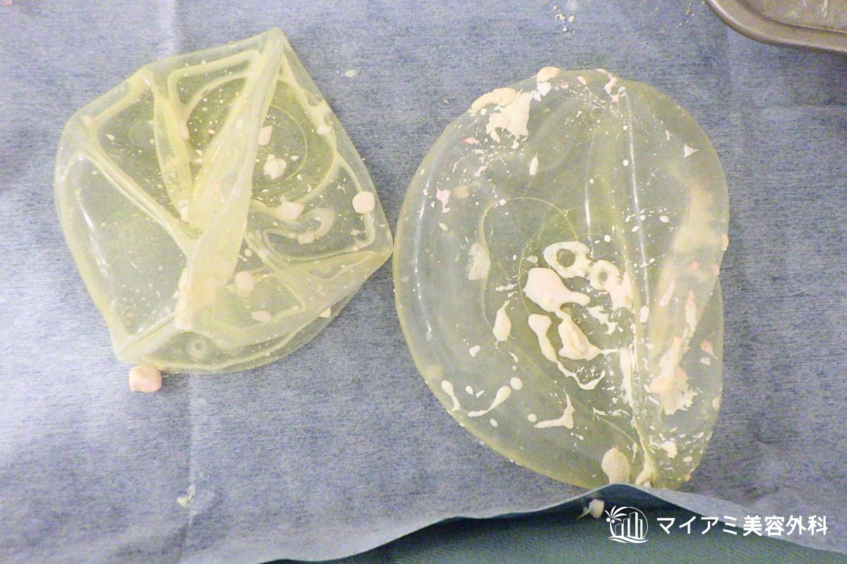 石灰化したシリコンバッグ