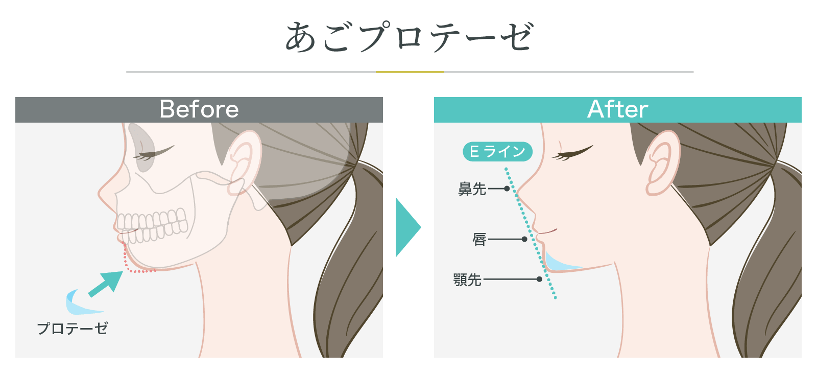 プロテーゼ