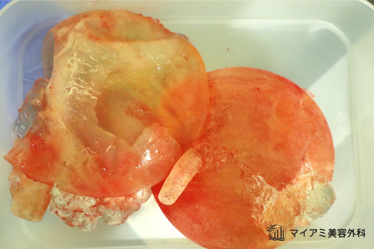 シリコンバッグで胸が変形していた方から取り出した破損したシリコンバッグ