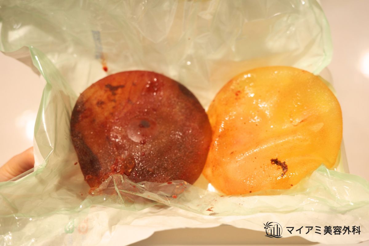 カプセル拘縮が起きているシリコンバッグ
