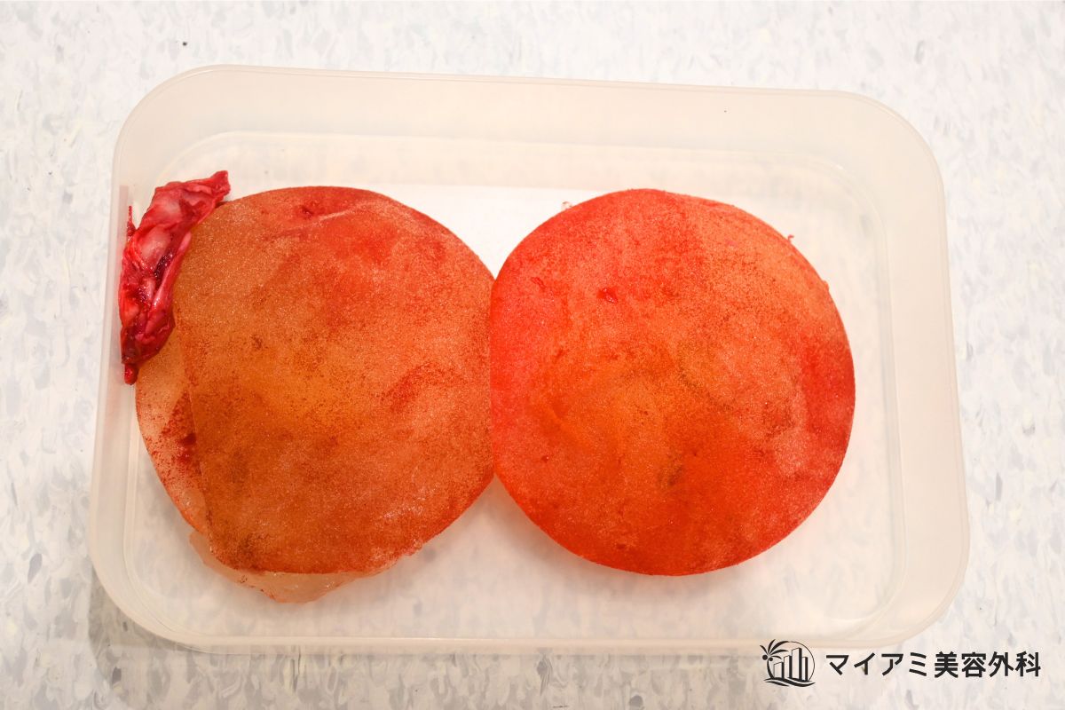血腫に包まれたシリコンバッグ