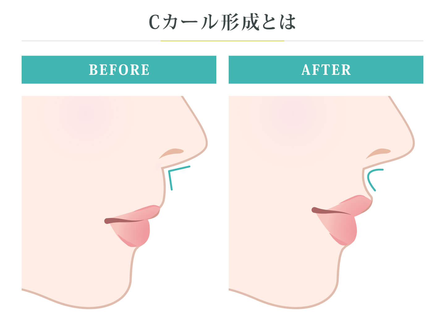 Cカール形成