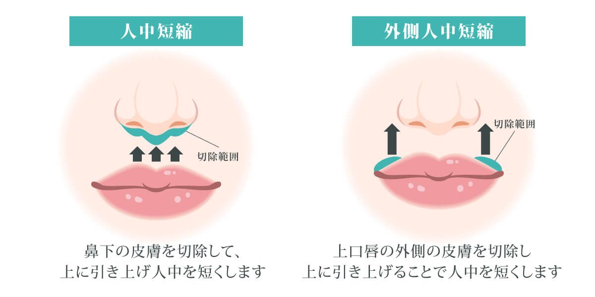 外側人中短縮
