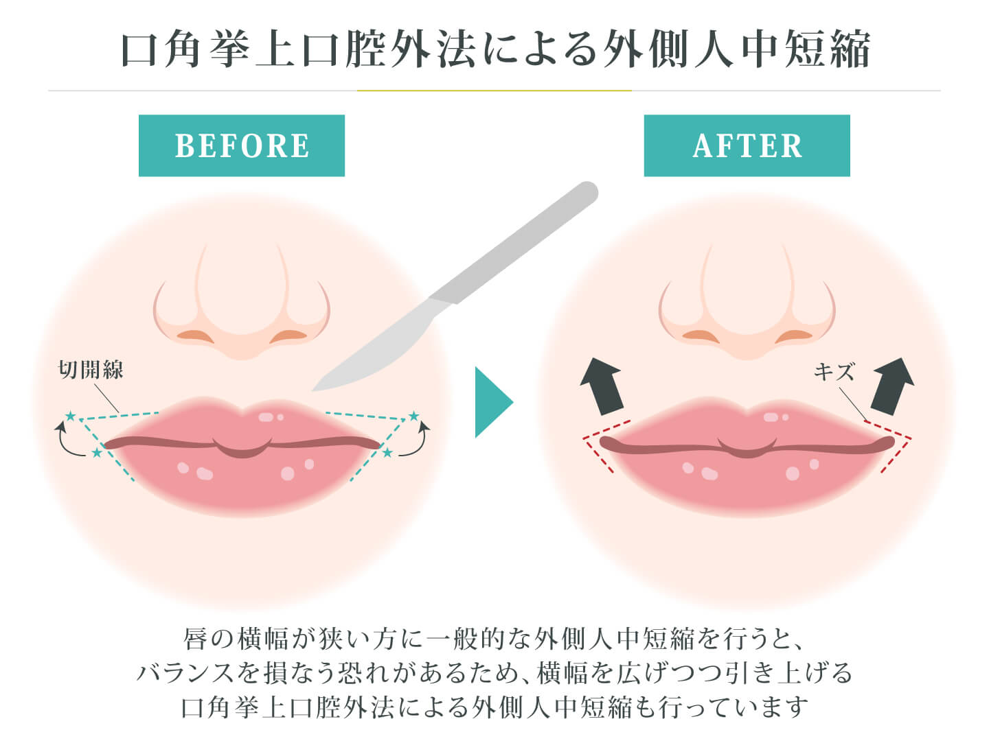 口角挙上口腔外法による外側人中短縮