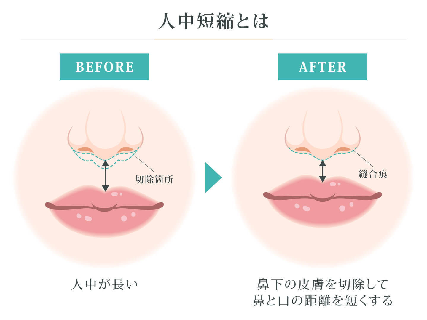 人中短縮