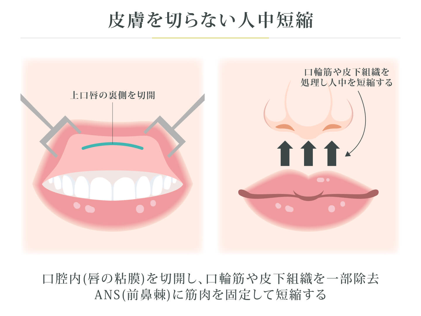 皮膚を切らない人中短縮