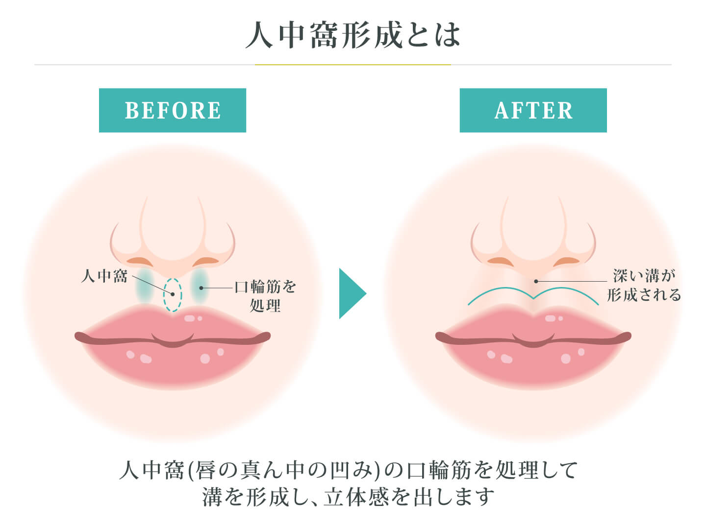 人中窩形成