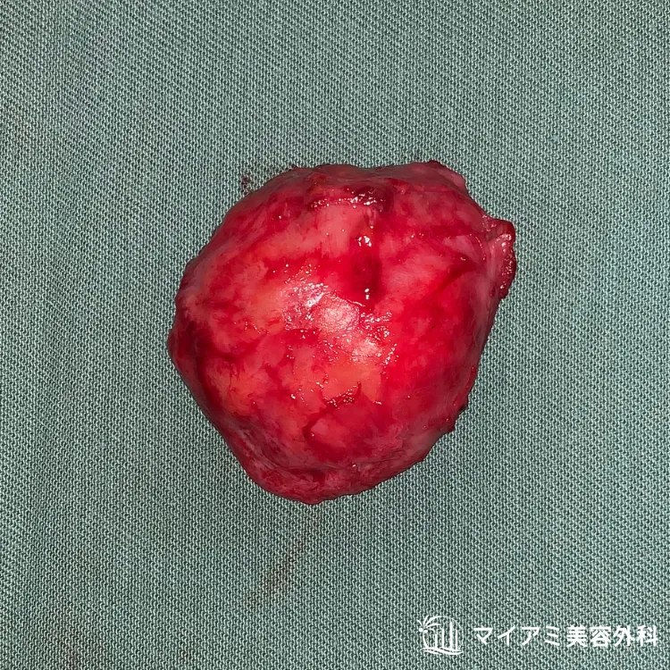 取り出した脂肪豊胸による充実性しこりの塊