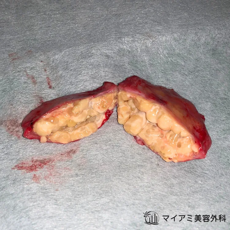 充実性しこりの塊に割を入れて中身を見たところ