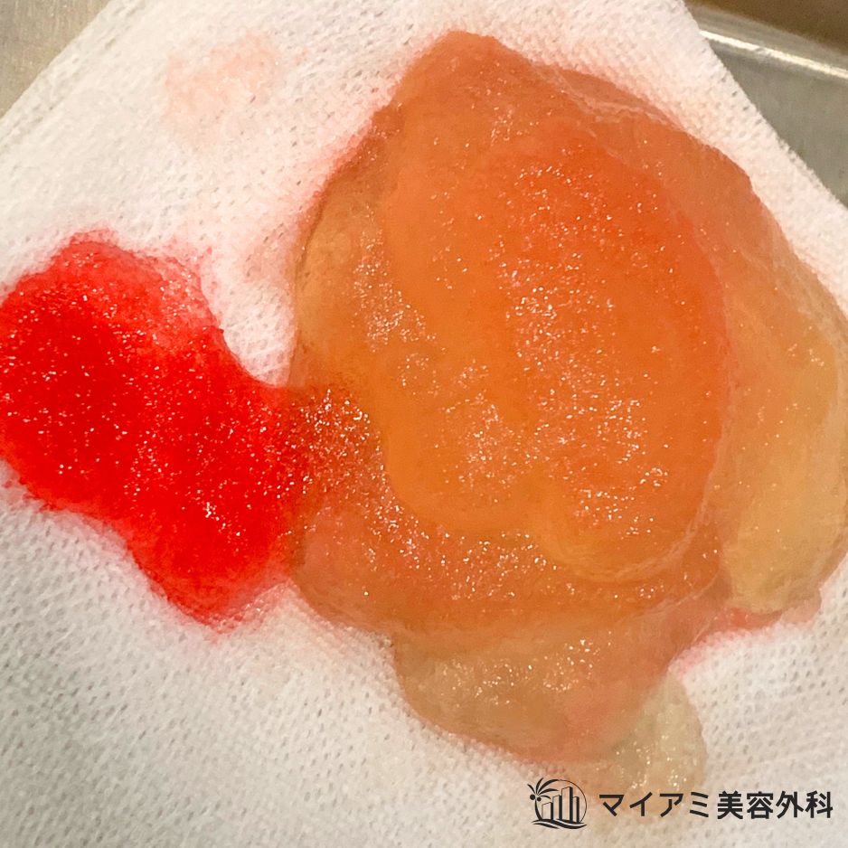 ヒアルロン酸のしこり