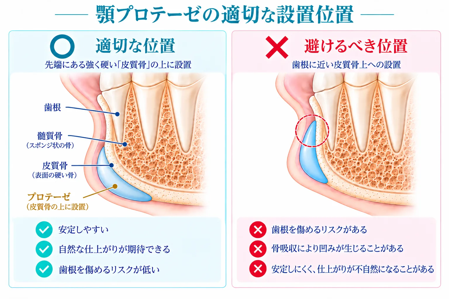 顎プロテーゼの適切な設置位置